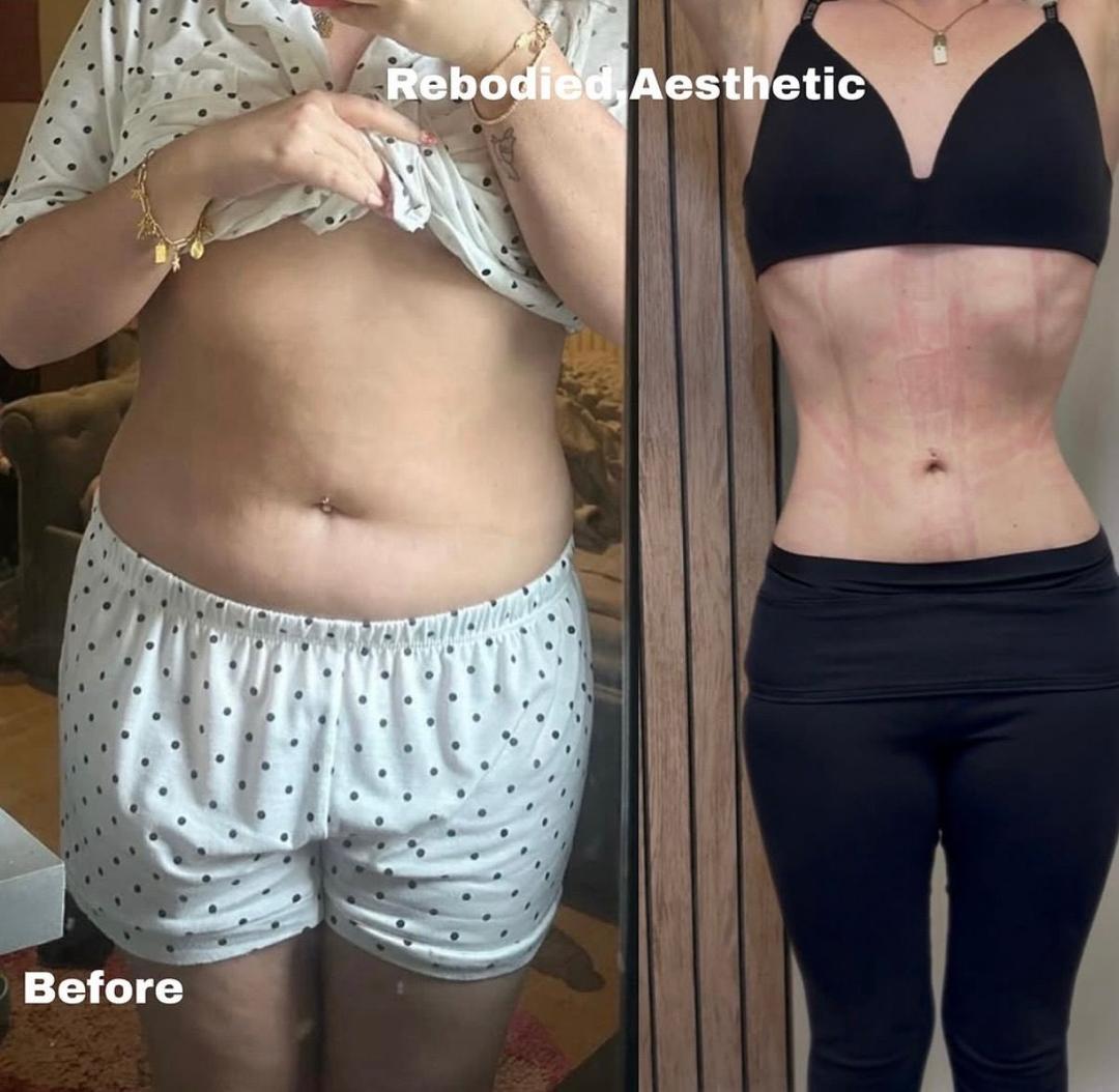 Before and after waist contouring result