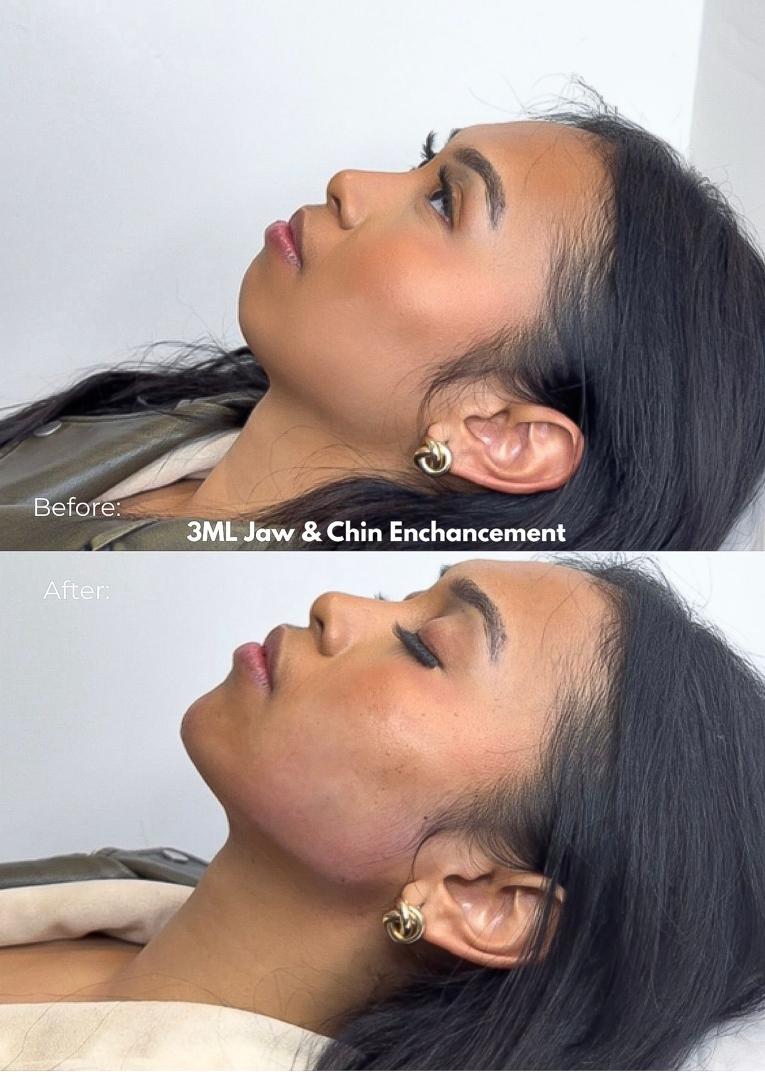 Before and after jaw and chin enhancement